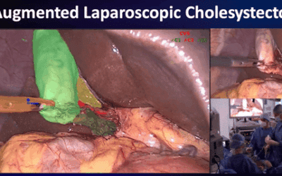 Scialytics : une spin-off de l’IHU développe le premier écosystème complet basé sur l’IA pour mesurer et réduire les risques chirurgicaux.