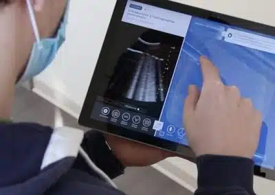 Projet ENSIST : InSimo et l’IHU Strasbourg lancent un module d’écho-endoscopie sur diSplay U/S