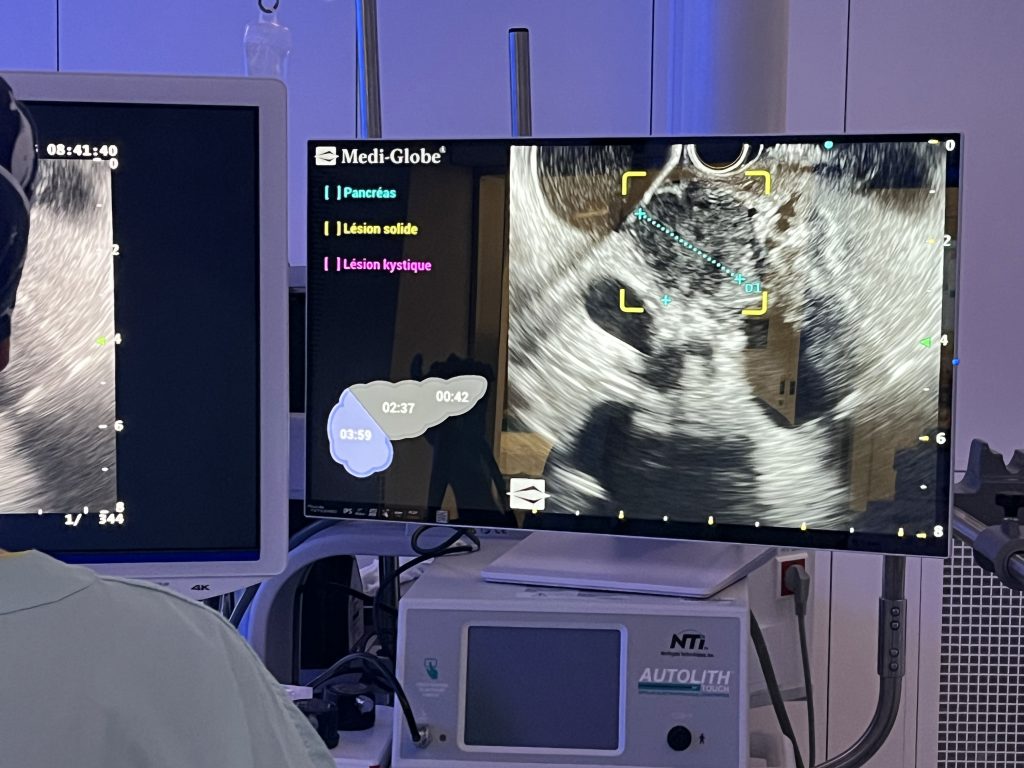 Assistance en Intelligence Artificielle (IA) mAI Companion® créant des annotations sur des zones spécifiques du pancréas lors de l’examen du patient