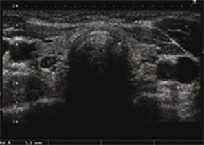 Hyperparathyroïdisme primaire echographie cervicale