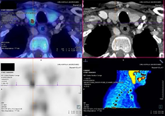Primary hyperparathyroidism, PET CT with FCholine