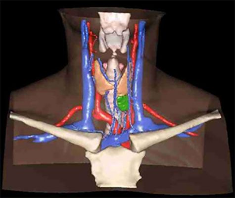 Primary hyperparathyroidism, 3D reconstruction