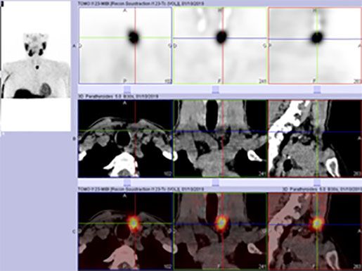 Primary hyperparathyroidism, MIBI scintigraphy