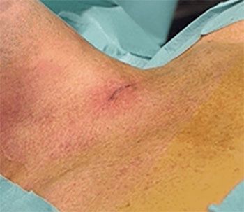 Hyperparathyroidism, Treatment